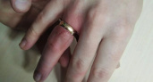 Тесное обручальное кольцо стало проблемой для жительницы Челябинской области